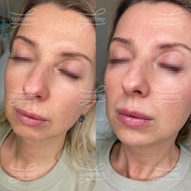 Коррекция подбородка