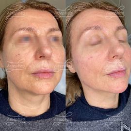 Коррекция подбородка