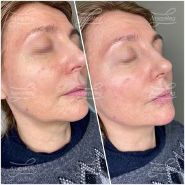 Коррекция подбородка