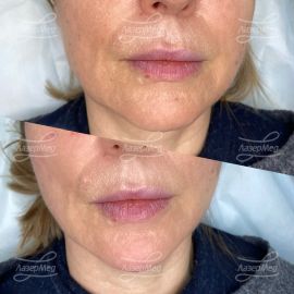 Коррекция подбородка