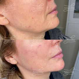 Коррекция подбородка