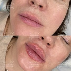 Контурная пластика губ