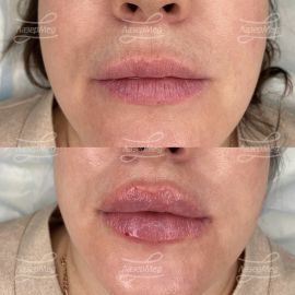 Контурная пластика губ