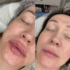 Контурная пластика губ