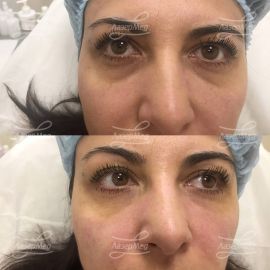 Коррекция носослезной борозды