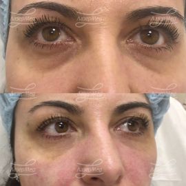 Коррекция носослезной борозды