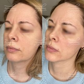 Коррекция подбородка