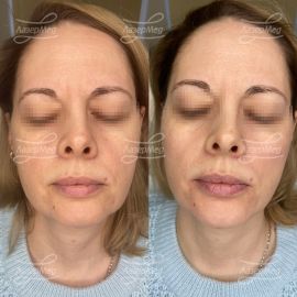 Коррекция подбородка