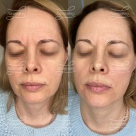 Коррекция подбородка