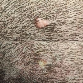 Лазерная деструкция невусов на волосистой части головы