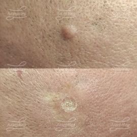 Лазерная деструкция невусов на волосистой части головы