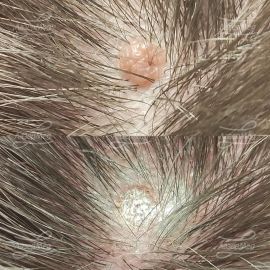 Лазерная деструкция невусов на волосистой части головы