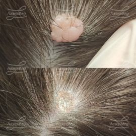 Лазерная деструкция невусов на волосистой части головы