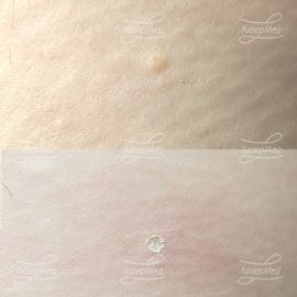 Лазерная деструкция кератомы