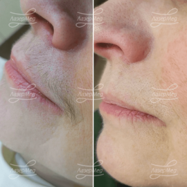 Лазерная эпиляция «усиков»