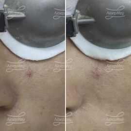 Лазерная коагуляции гемангиомы