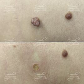 Лазерная деструкция невусов