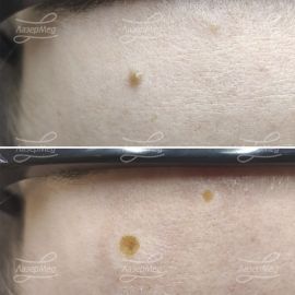 Лазерная деструкция невусов