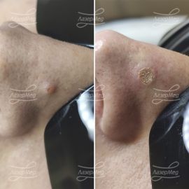 Лазерная деструкция невусов