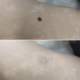 Лазерная деструкция невусов