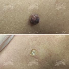 Лазерная деструкция невусов