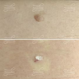 Лазерная деструкция невусов