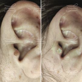 Лазерная деструкция невусов