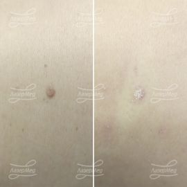 Лазерная деструкция невуса