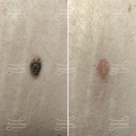 Лазерная деструкция кератомы