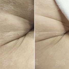 Лазерная деструкция папилломы