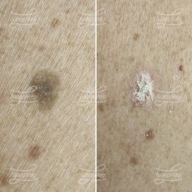 Лазерная деструкция кератом