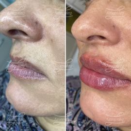 Контурная пластика губ