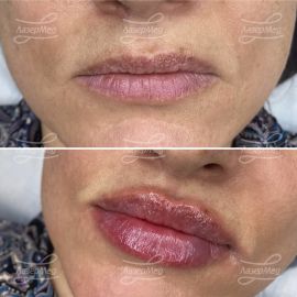 Контурная пластика губ