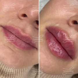 Контурная пластика губ