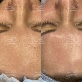 Миндальный пилинг