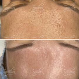 Миндальный пилинг