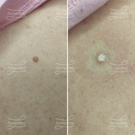 Лазерная деструкция невусов