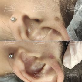 Лазерная деструкция невуса на коже ушной раковины, (До и через 21 день)