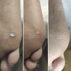 Лазерная деструкция вирусной бородавки на коже стопы (До, сразу после и через 21 день)
