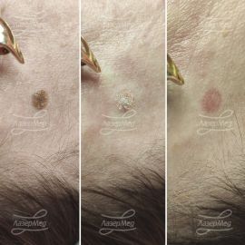 Лазерная деструкция кератомы, (До, сразу после и через 14 дней)