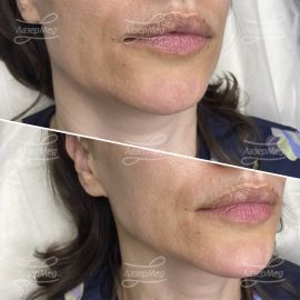 Коррекция подбородка