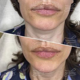 Коррекция подбородка