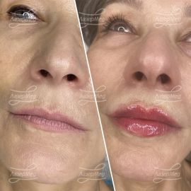 Контурная пластика губ