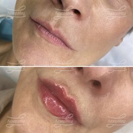 Контурная пластика губ