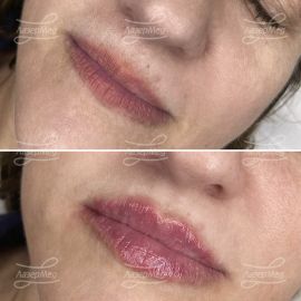 Контурная пластика губ
