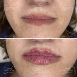 Контурная пластика губ