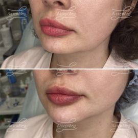 Коррекция подбородка