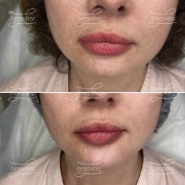 Коррекция подбородка