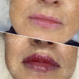Контурная пластика губ