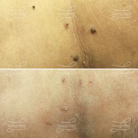 удаление папиллом на шее